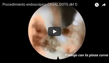 Cirugía endoscópica transforaminal Doctor Ricardo Casal [VIDEO]