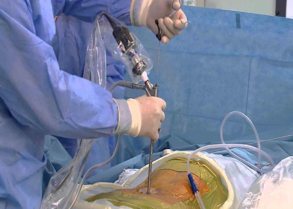 ¿Qué es la cirugía endoscópica interlaminar?