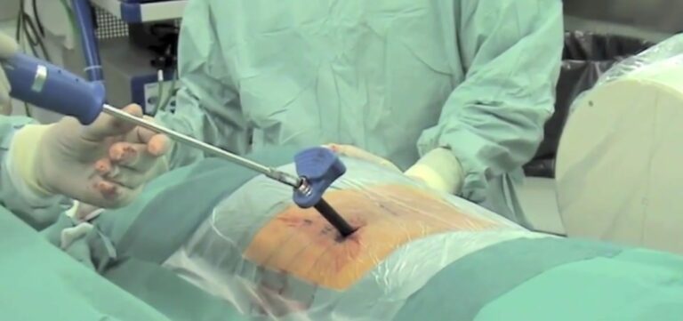 Ventajas de la cirugía de fusión lumbar por endoscopia
